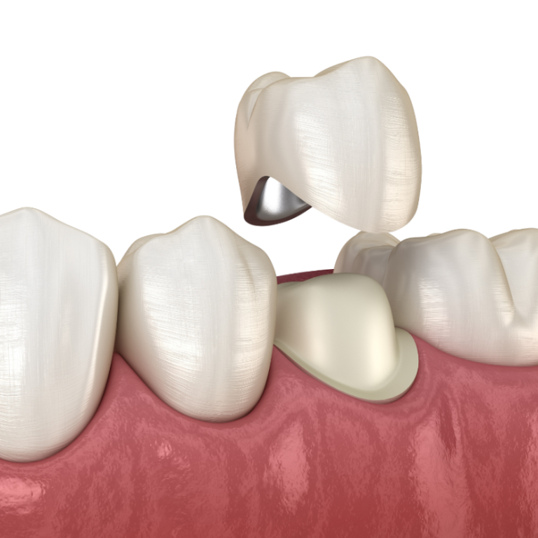 Dental Crowns Stroud